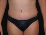 Tummy Tuck - Case Case 7 - After