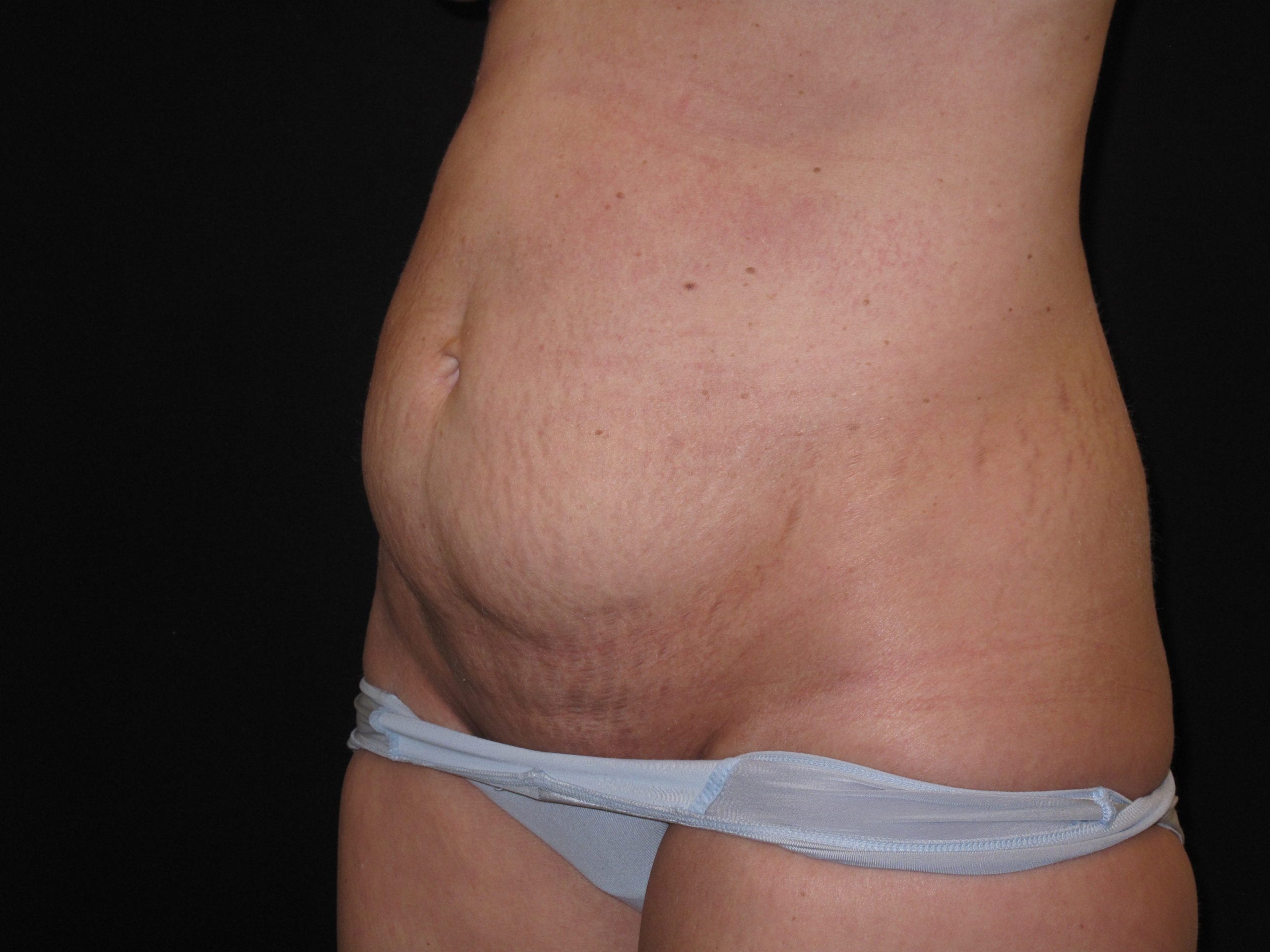 Tummy Tuck Patient Photo - Case Case 14 - before view-1