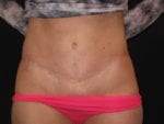 Tummy Tuck - Case Case 14 - After