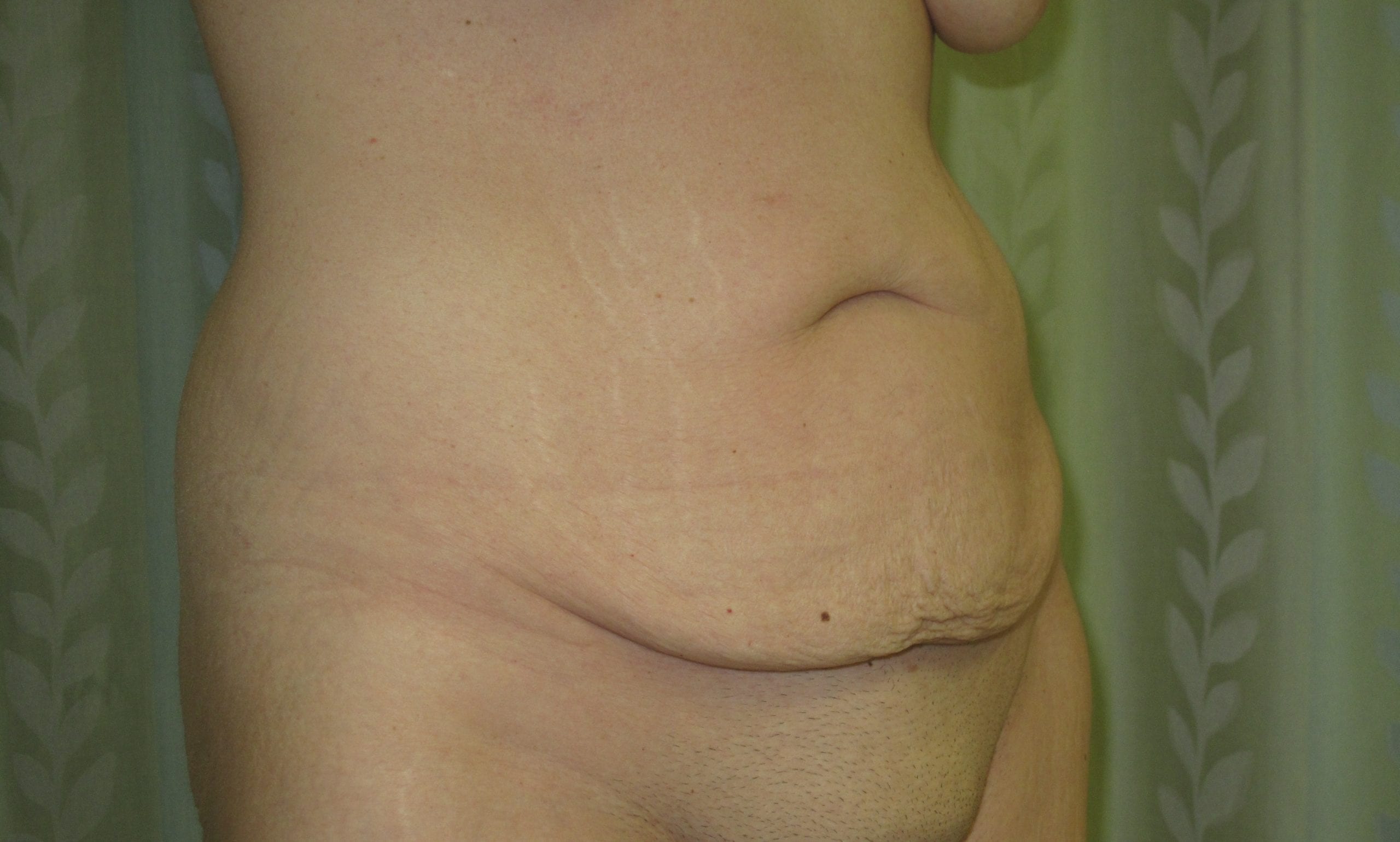 Tummy Tuck Patient Photo - Case Case 15 - before view-1