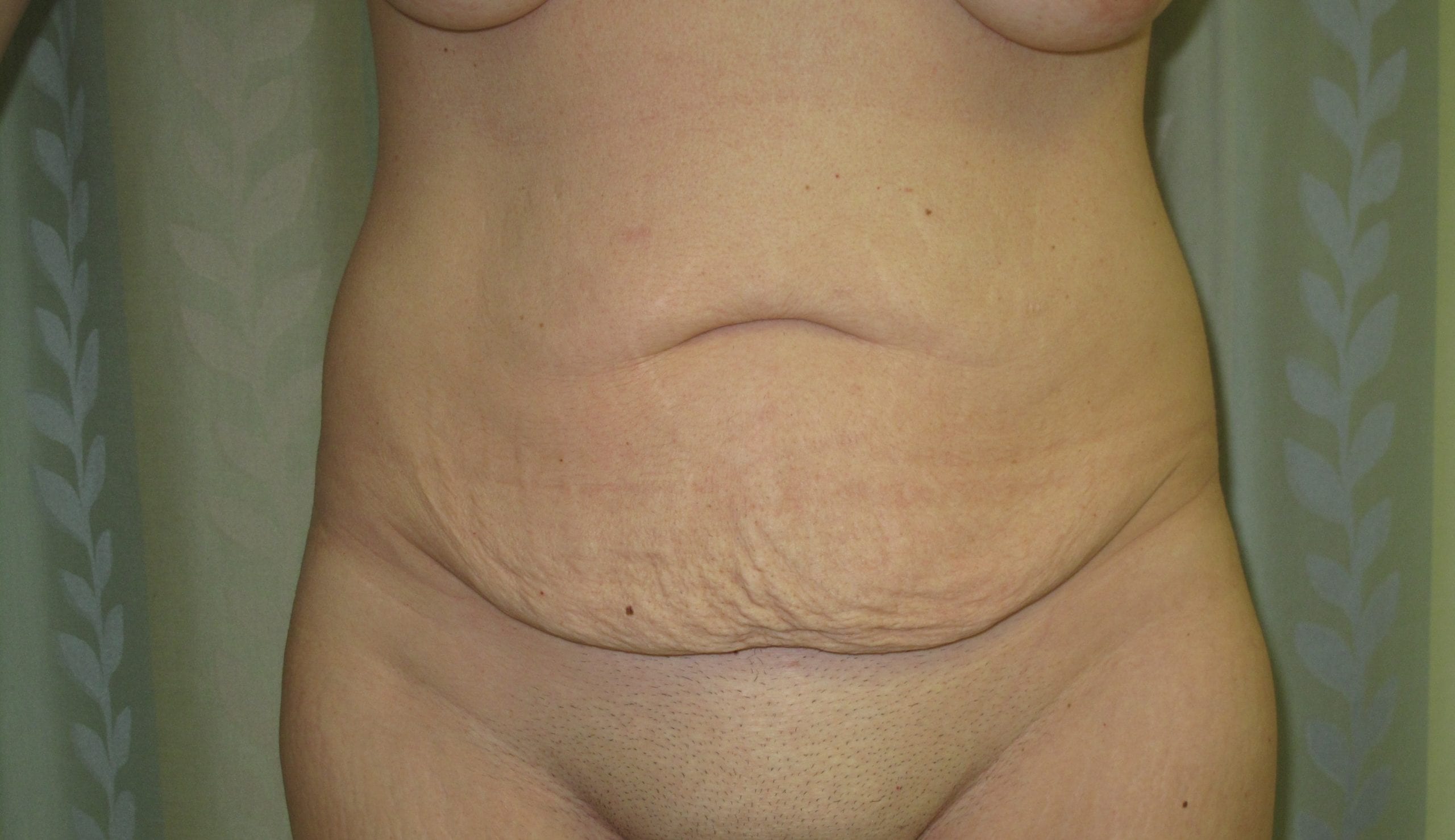 Tummy Tuck Patient Photo - Case Case 15 - before view-0