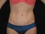 Tummy Tuck - Case Case 15 - After