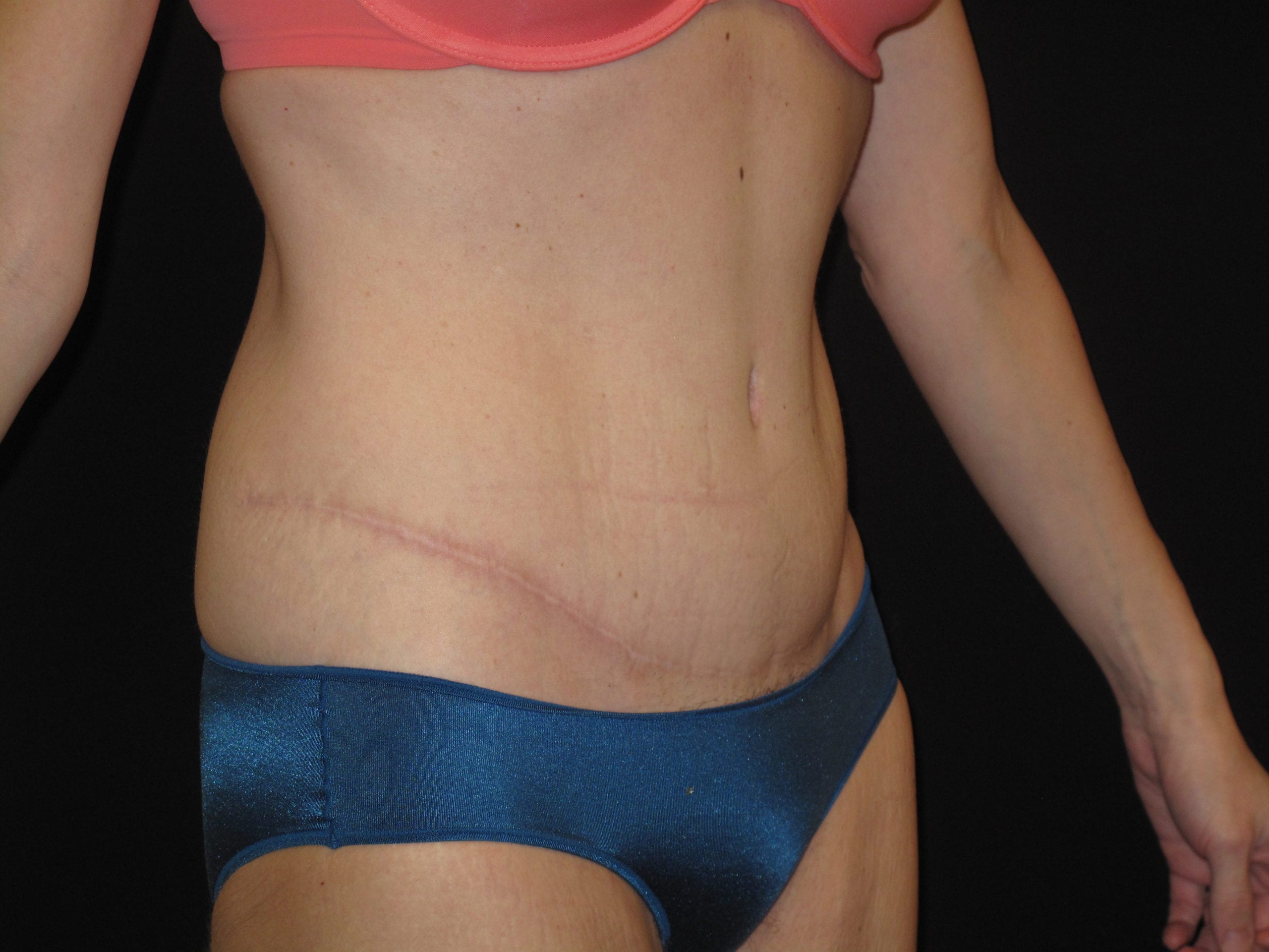 Tummy Tuck Patient Photo - Case Case 15 - after view-1