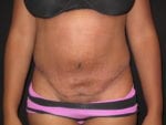 Tummy Tuck - Case Case 16 - After