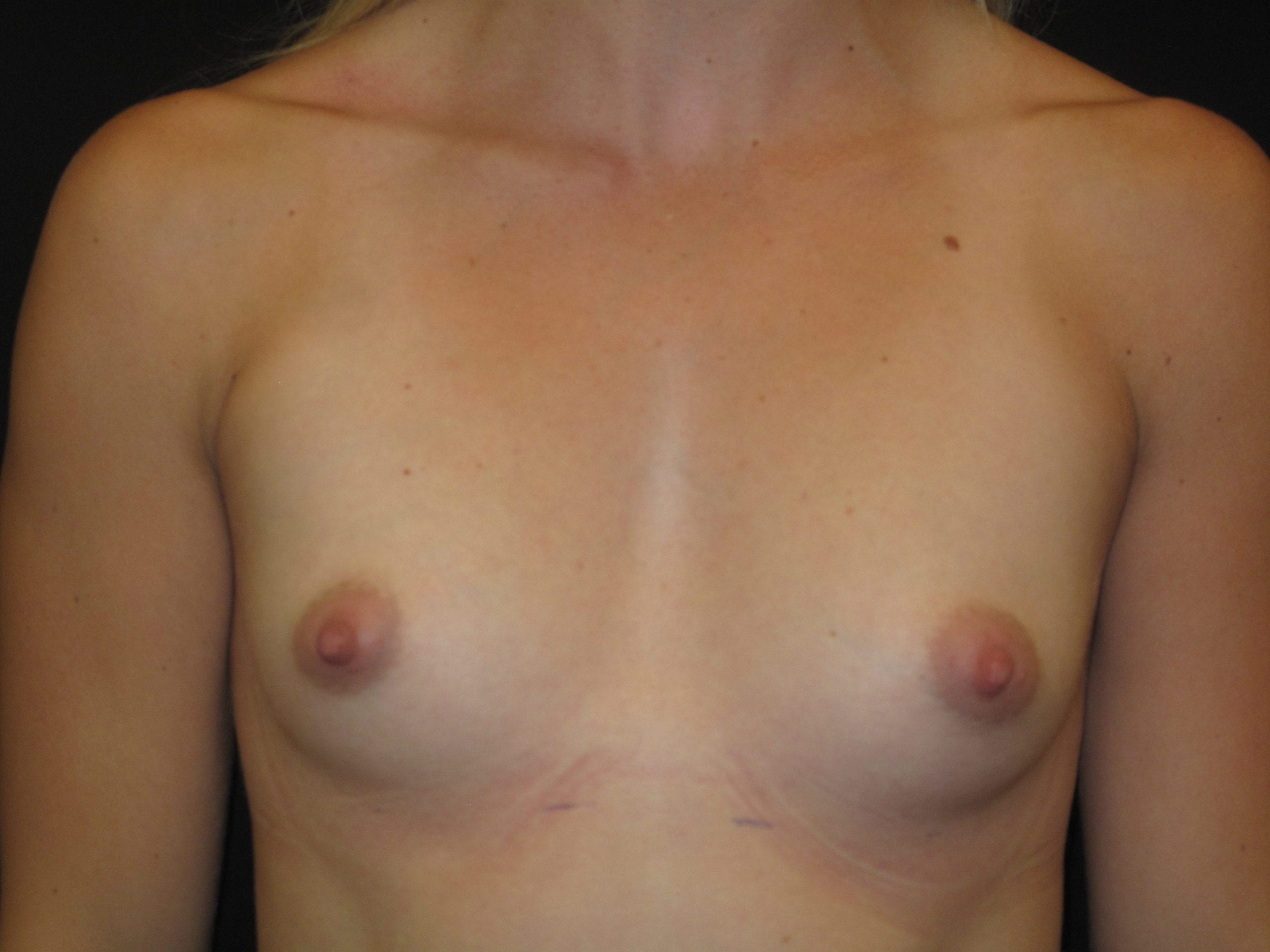 Breast Augmentation Patient Photo - Case Case 32 - before view-0