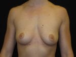 Breast Augmentation - Case Case 8 - Before