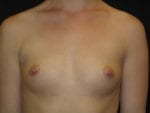 Breast Augmentation - Case Case 30 - Before