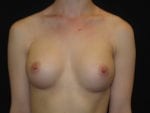 Breast Augmentation - Case Case 30 - After
