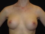 Breast Augmentation - Case Case 30 - After