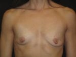 Breast Augmentation - Case Case 35 - Before