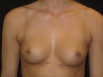 Breast Augmentation - Case Case 34 - Before