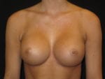 Breast Augmentation - Case Case 34 - After
