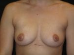 Breast Augmentation - Case Case 53 - Before