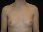 Breast Augmentation - Case Case 36 - Before