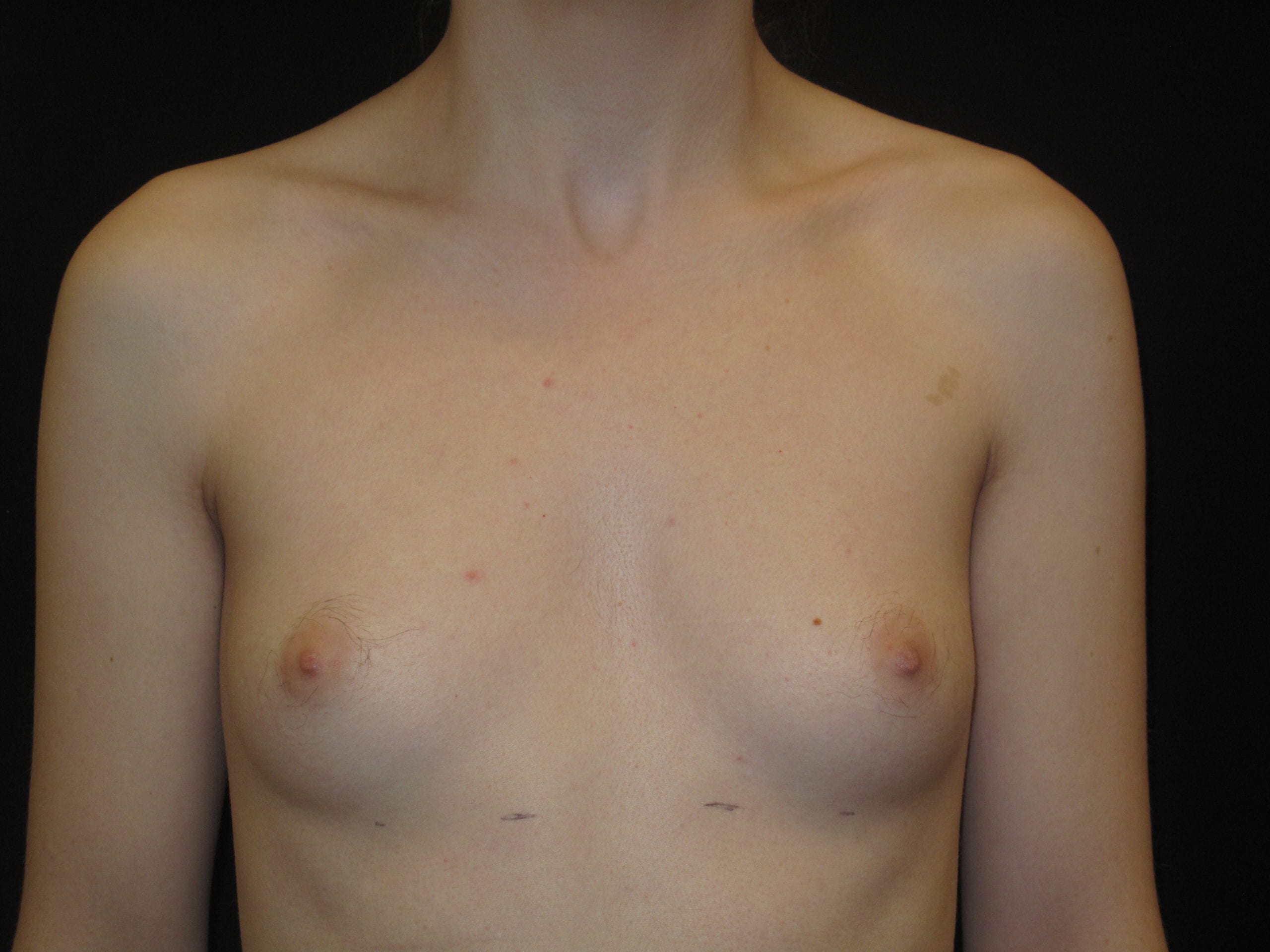 Breast Augmentation Patient Photo - Case Case 36 - before view-