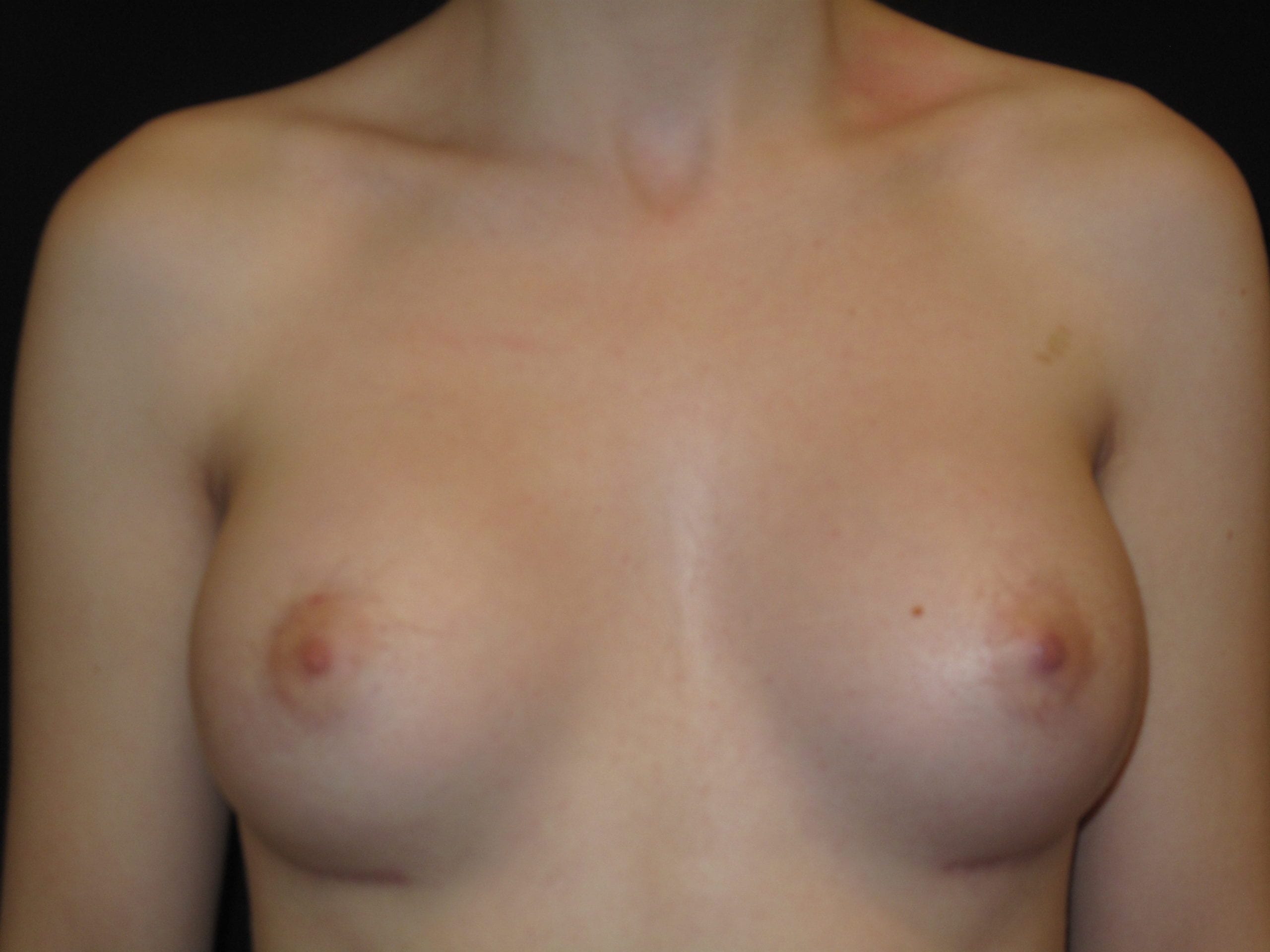 Breast Augmentation Patient Photo - Case Case 36 - after view