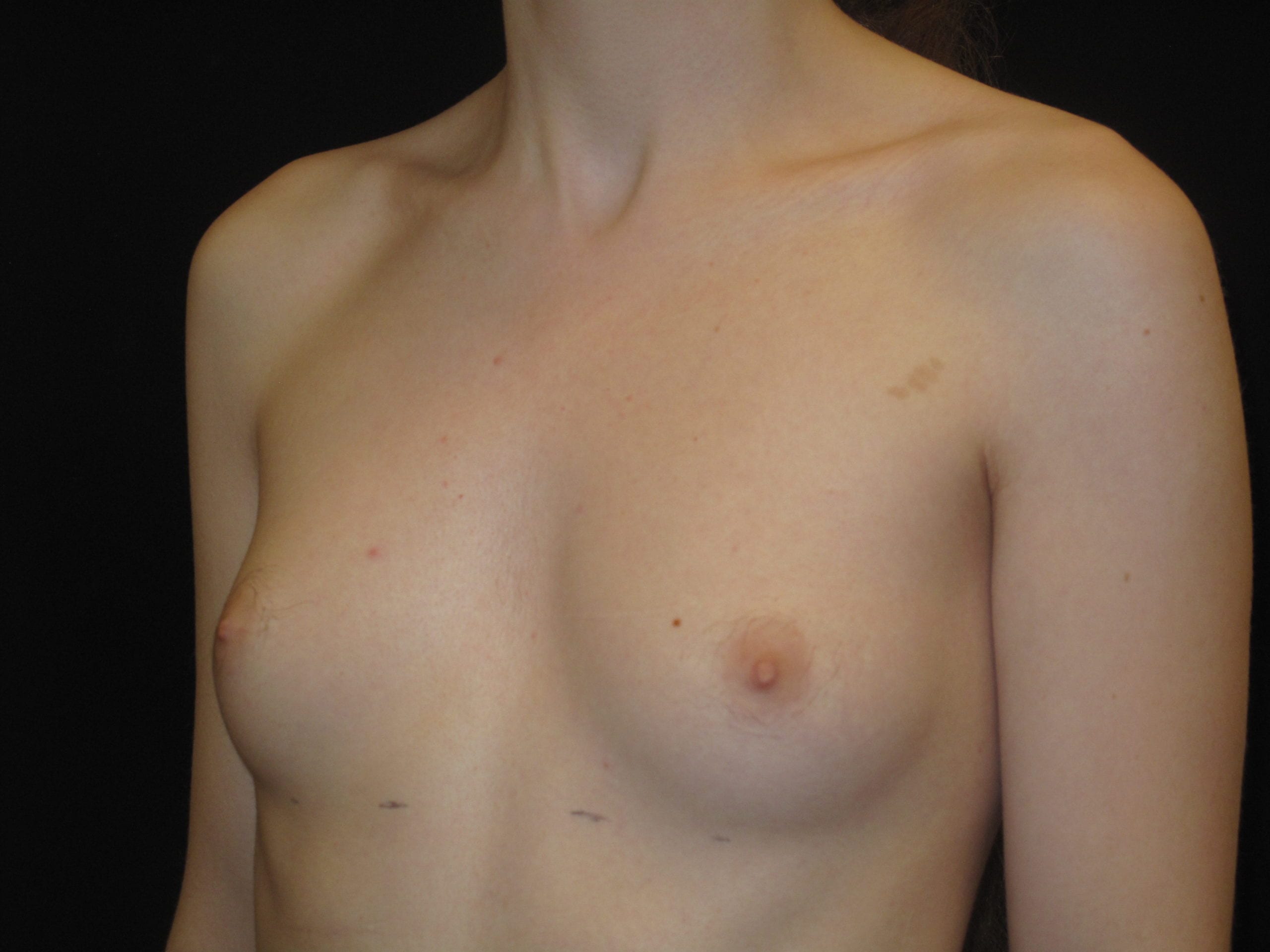 Breast Augmentation Patient Photo - Case Case 36 - before view-1