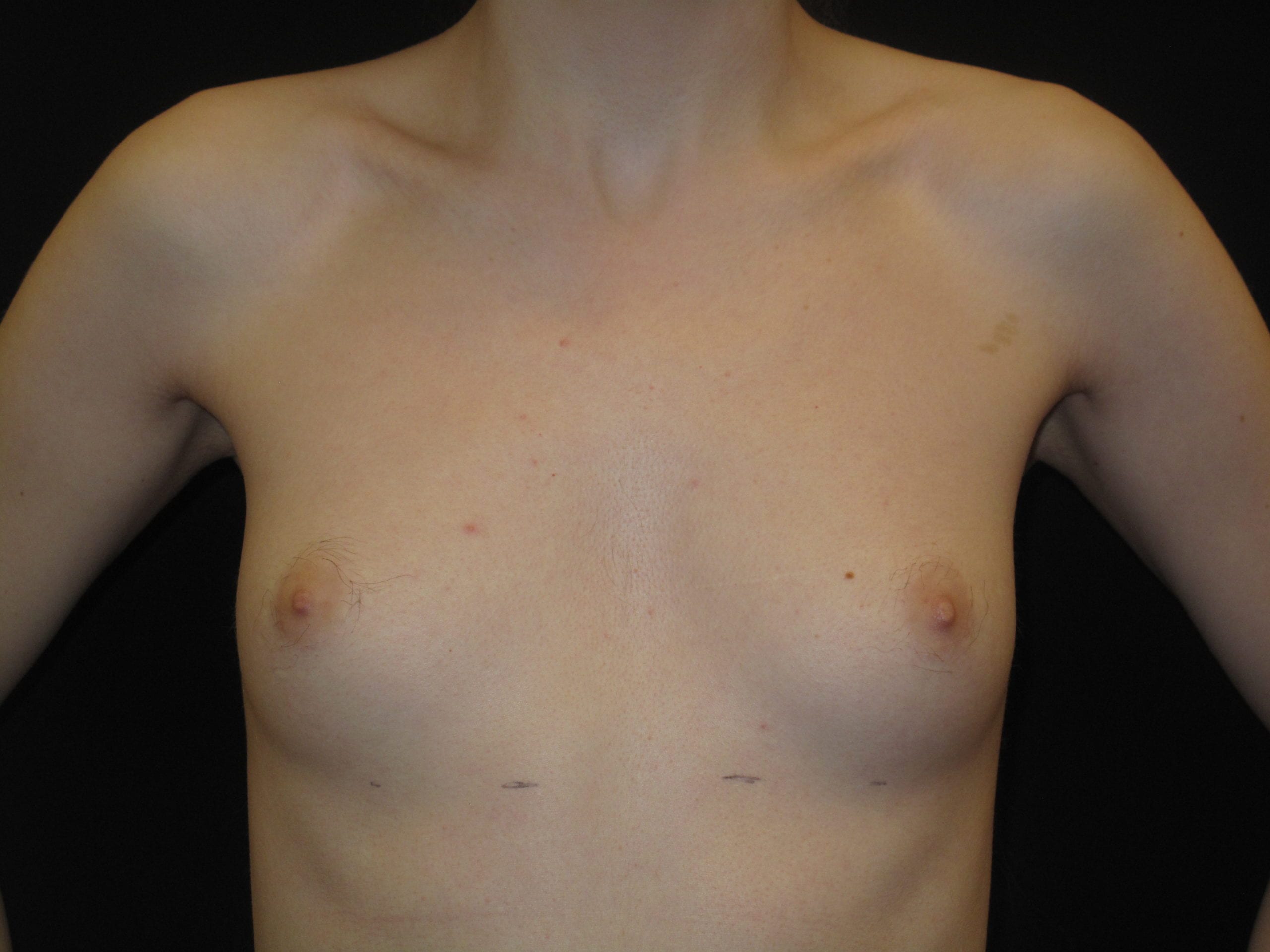 Breast Augmentation Patient Photo - Case Case 36 - before view-2