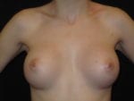 Breast Augmentation - Case Case 36 - After