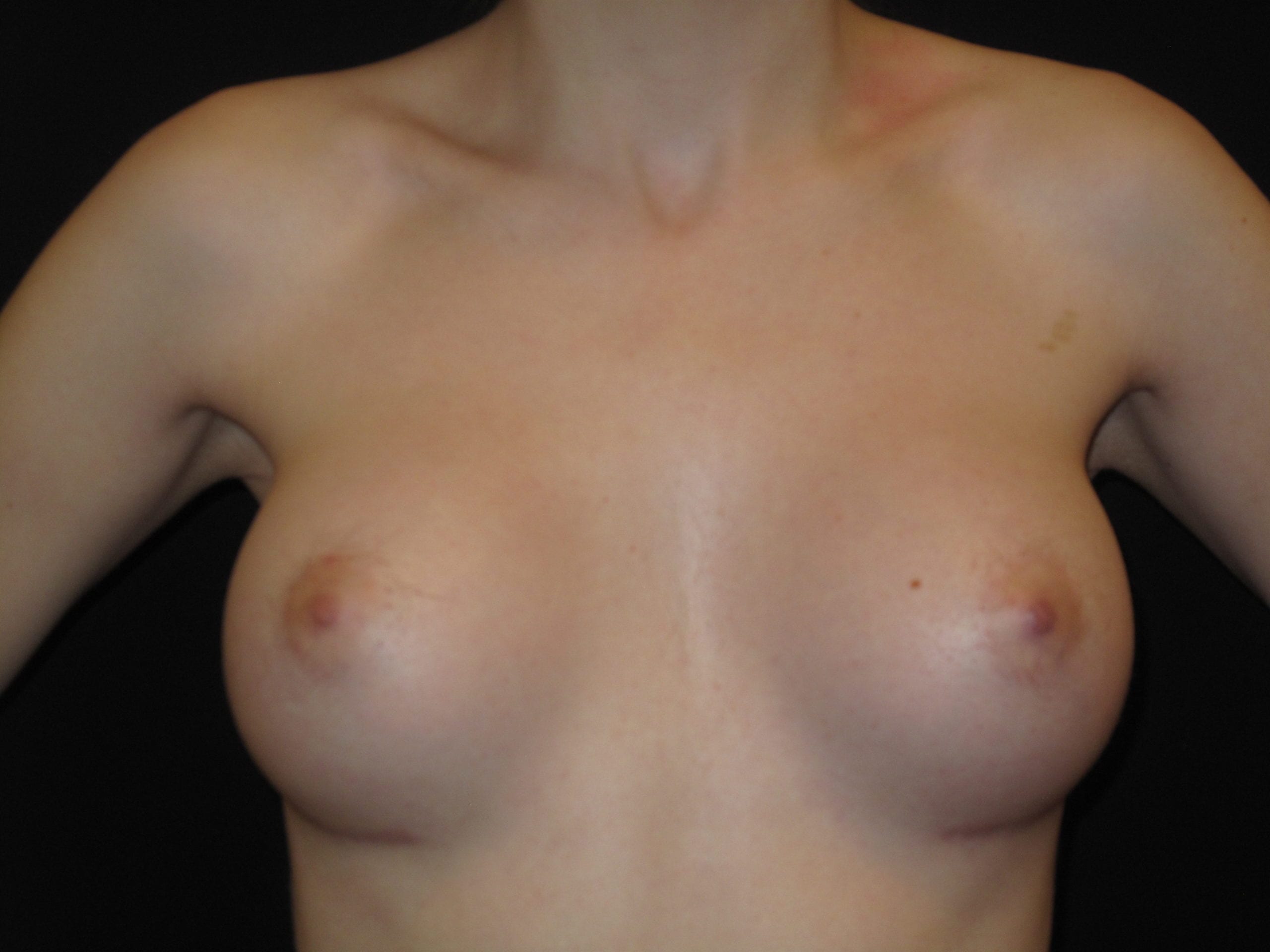 Breast Augmentation Patient Photo - Case Case 36 - after view-2