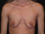 Breast Augmentation - Case Case 37 - Before