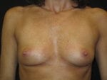 Breast Augmentation - Case Case 41 - Before