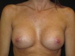 Breast Augmentation - Case Case 41 - After