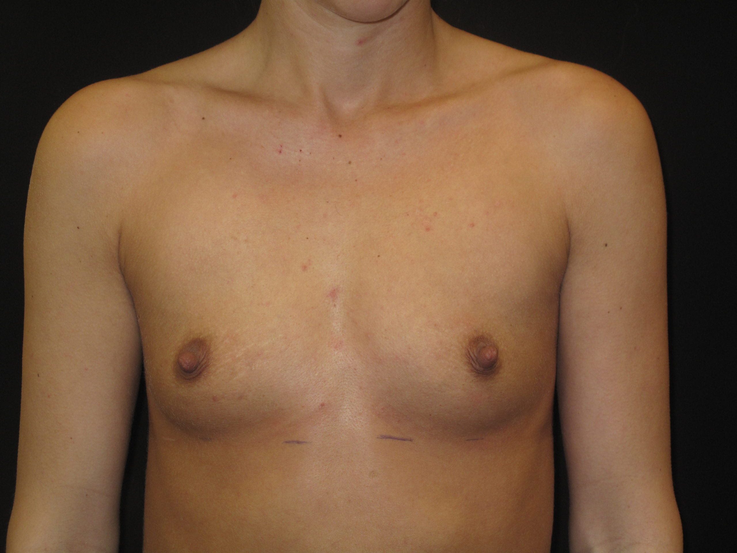 Breast Augmentation Patient Photo - Case Case 39 - before view-