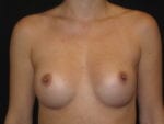 Breast Augmentation - Case Case 39 - After