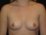 Breast Augmentation - Case Case 3 - Before