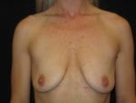 Breast Lift w/ Augmentation - Case Case 2 - Before