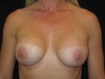 Breast Lift w/ Augmentation - Case Case 2 - After