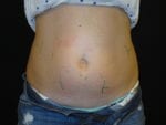 Coolsculpting - Case Case 7 - Before