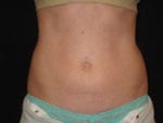 Coolsculpting - Case Case 7 - After