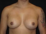 Breast Augmentation - Case Case 48 - After