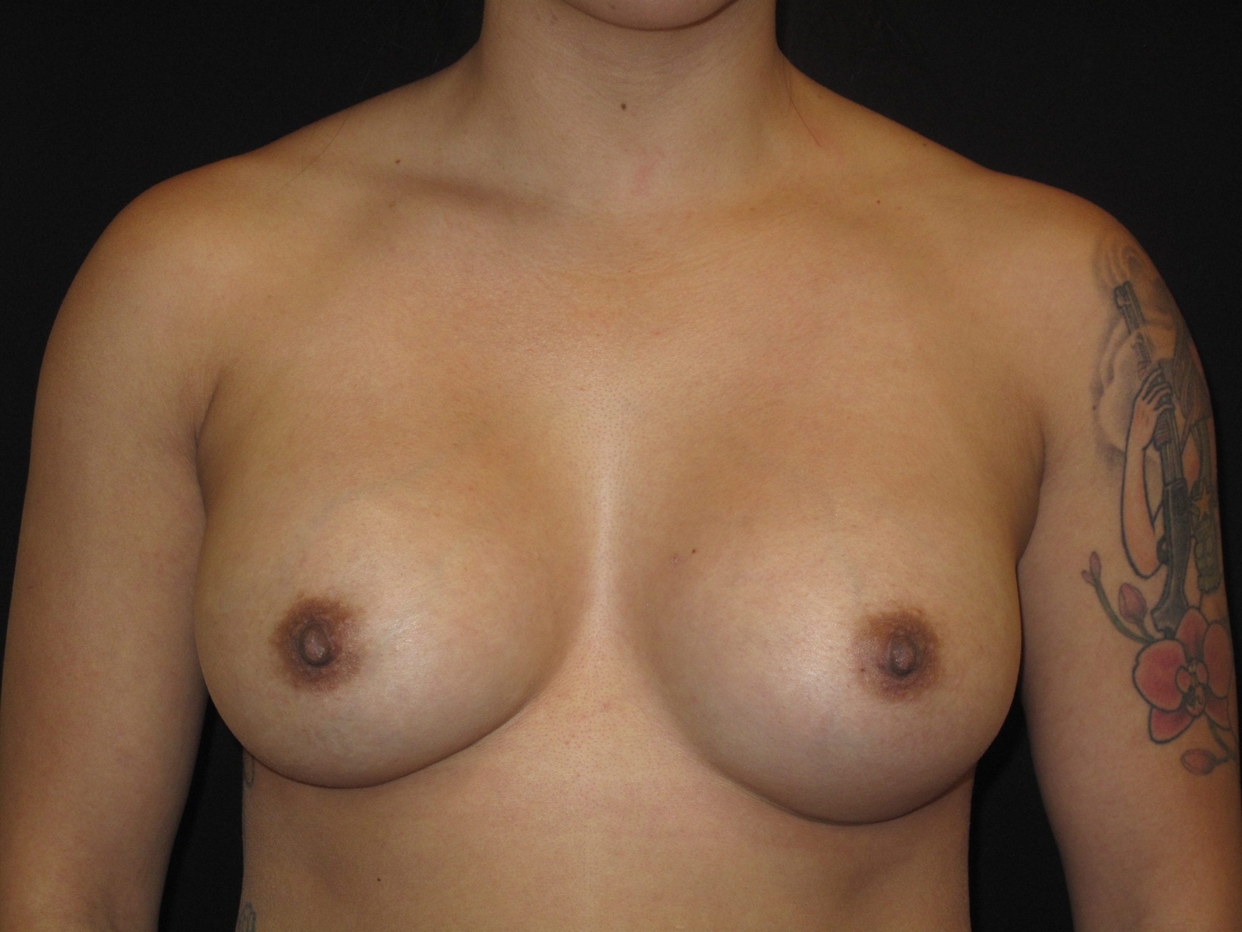 Breast Augmentation Patient Photo - Case Case 48 - after view