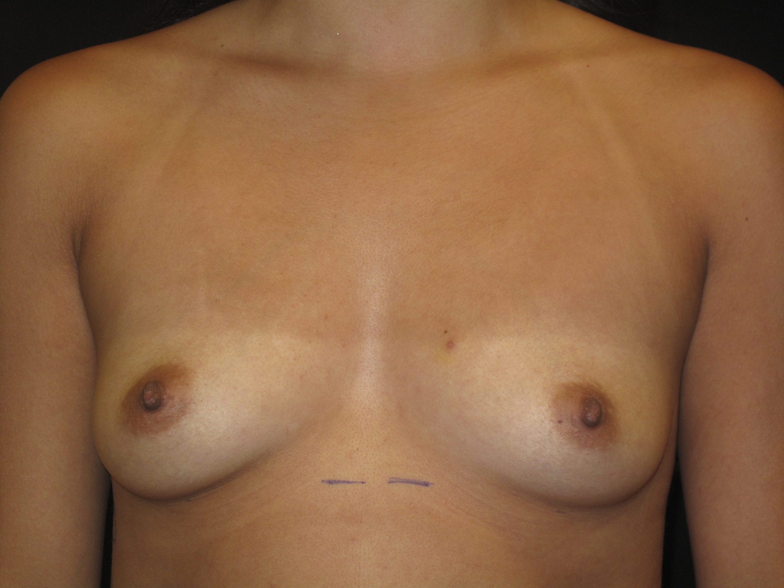 Breast Augmentation Patient Photo - Case Case 48 - before view-0