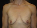 Breast Augmentation - Case Case 51 - Before