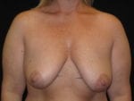 Breast Lift w/ Augmentation - Case Case 18 - Before