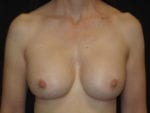Breast Implant Revision - Case Case 3 - After