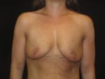 Breast Lift w/ Augmentation - Case Case 19 - Before