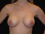 Breast Augmentation - Case Case 52 - After