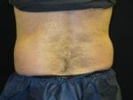 Coolsculpting - Case Case 9 - Before