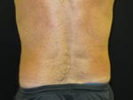 Coolsculpting - Case Case 9 - After