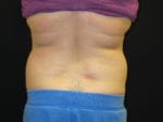Coolsculpting - Case Case 11 - Before