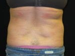 Coolsculpting - Case Case 11 - After