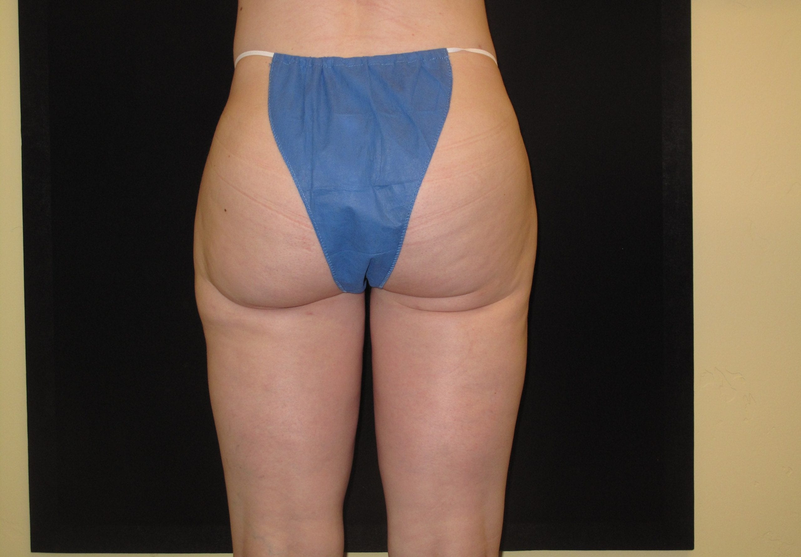 Liposuction Patient Photo - Case Case 1 - after view-1