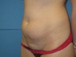 Liposuction - Case Case 2 - Before