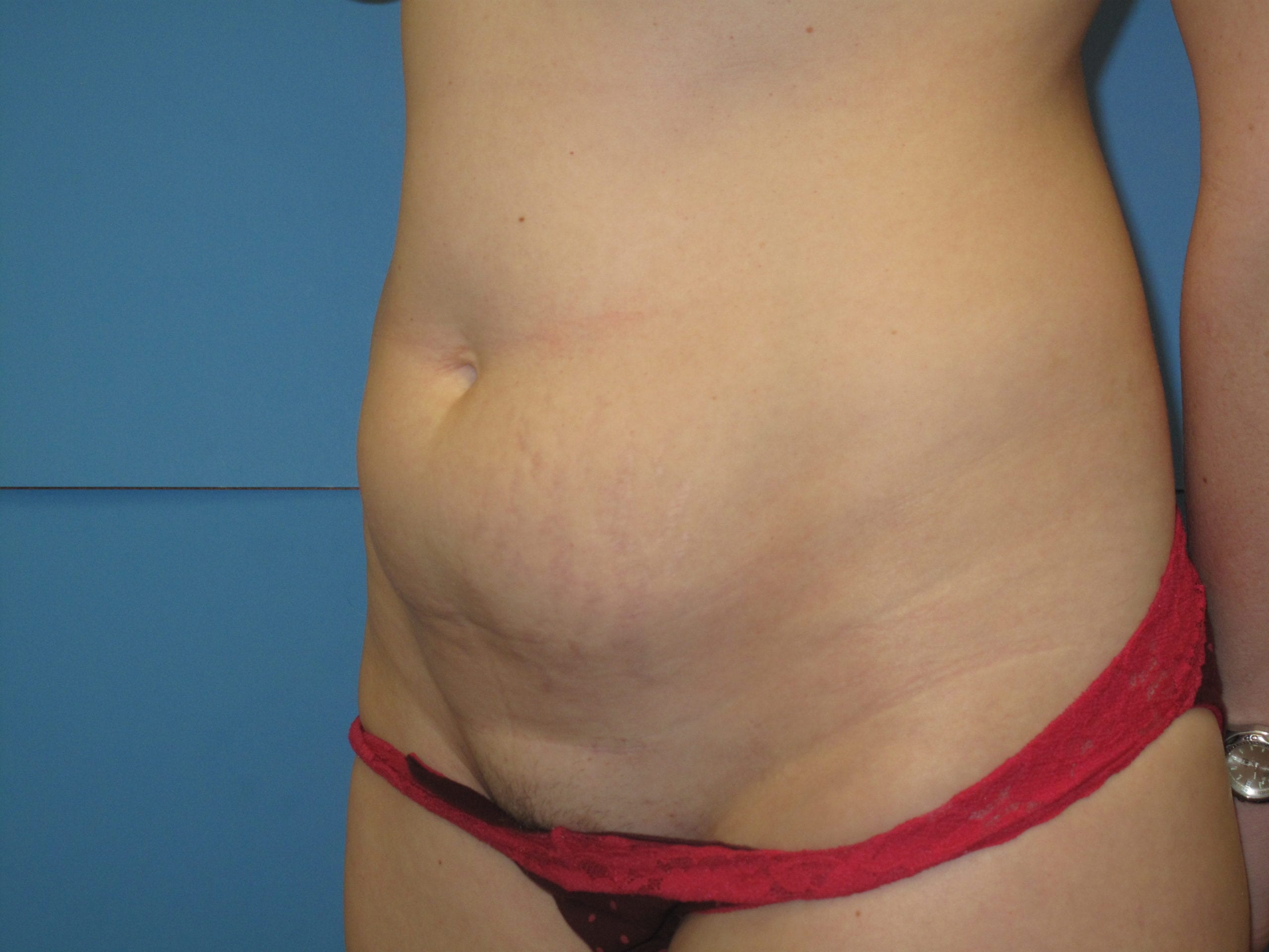 Liposuction Patient Photo - Case Case 2 - before view-
