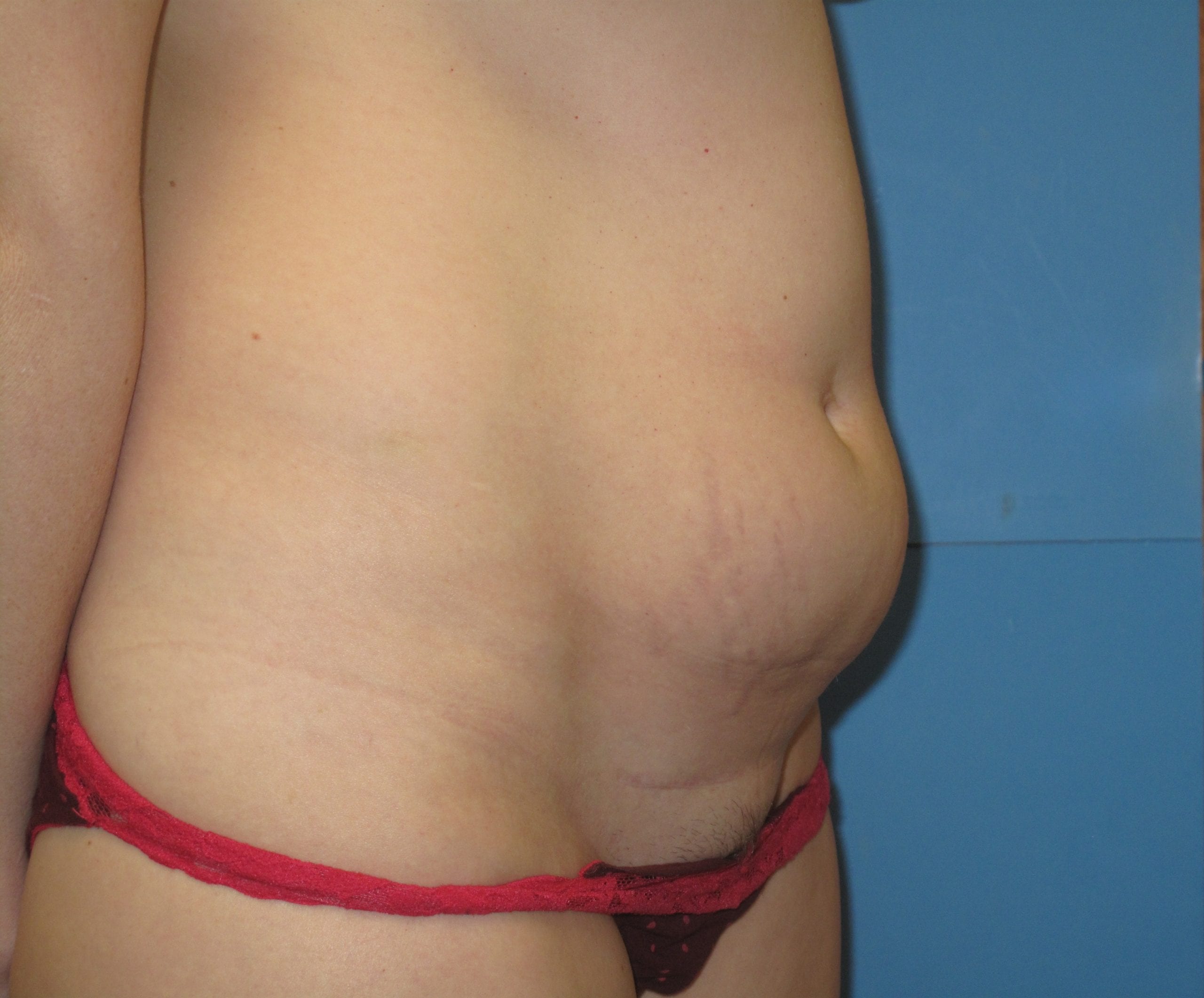 Liposuction Patient Photo - Case Case 2 - before view-1
